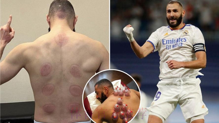 本泽马假期期间每天训练 今天接受了拔罐理疗 本泽马假期期间每天训练 今天接受了拔罐理疗